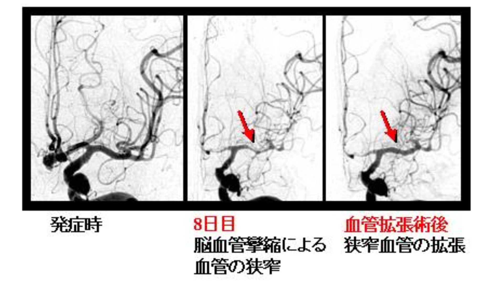 脳血管攣縮画像例